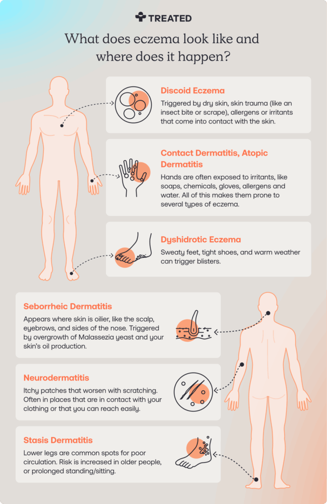 Infographic displaying what eczema looks like and where it occurs.
