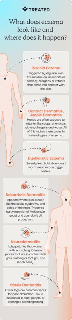How can eczema look__M